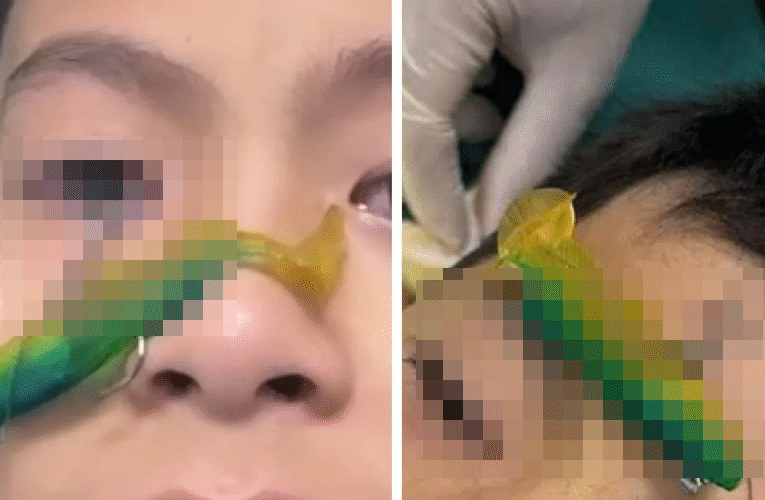 ẢNH KHONG CHE: Bé trai ở Bắc Ninh bị mo’c câu cá đam xuyên nhãn cầu